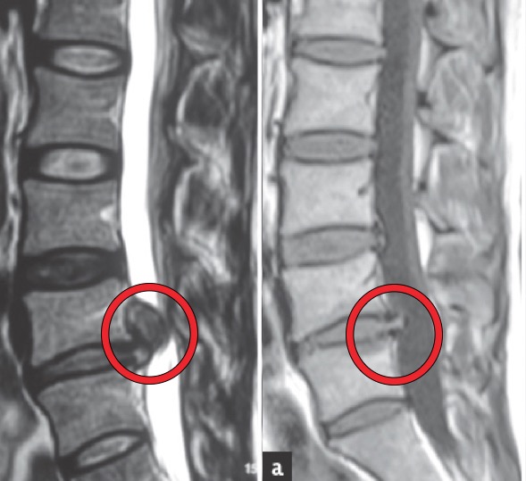 can-i-recover-from-a-slipped-disc-the-physios-sheffield