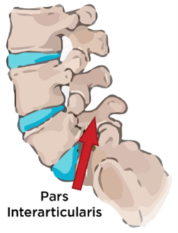 Lumbar bone stress injury/ spondylosis/ pars defect