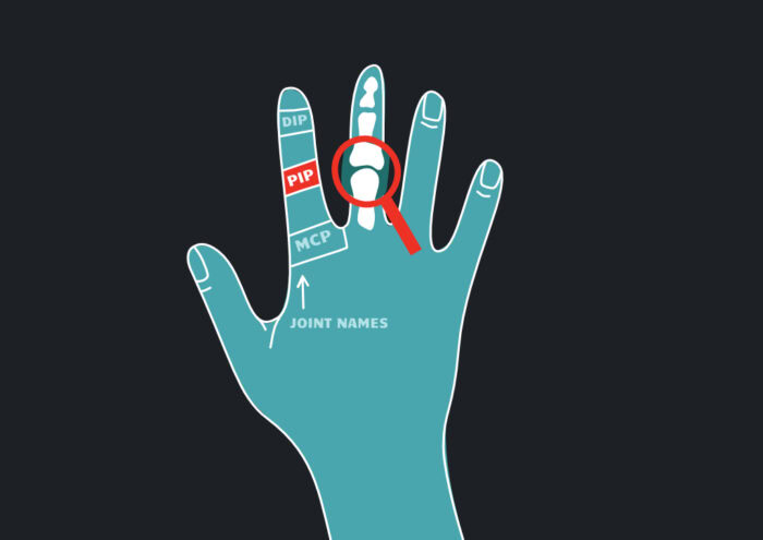 A diagram of the hand, which shows the most common site of a growth plate fracture in the fingers.